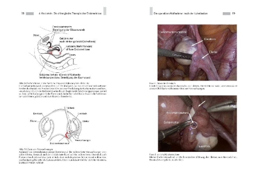 Buchcover und Innenansicht für das Buch: Endometriose - Die verkannte Frauenkrankheit