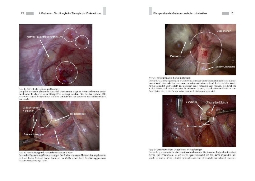 Buchcover und Innenansicht für das Buch: Endometriose - Die verkannte Frauenkrankheit